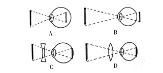 2014中考物理复习必备考点调研题27:区别近视眼和远视