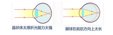 「2024年中考物理要点」近视眼与远视眼